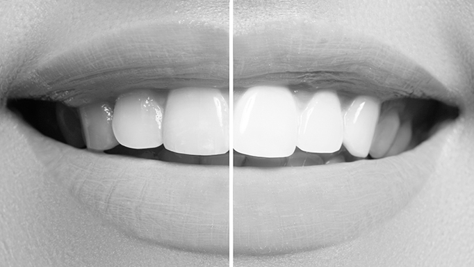 conseguir dientes blancos