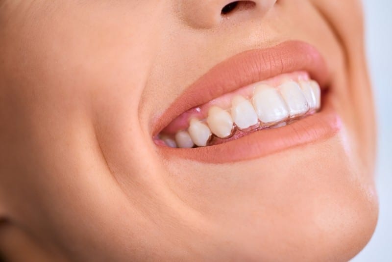 Que Son Ferulas Descarga Bruxismo